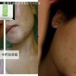 视频怎么去痘,如何根据视频有效去痘，告别痘痕困扰